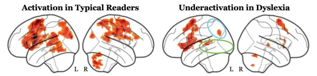 Two heat maps comparing brain activation in typical readers and those with dyslexia. 